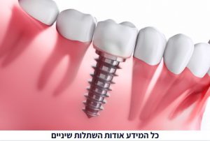 מה זה באמת השתלות שיניים?